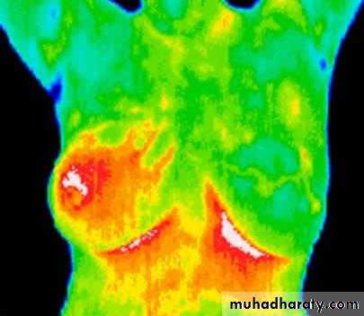 breast cancer