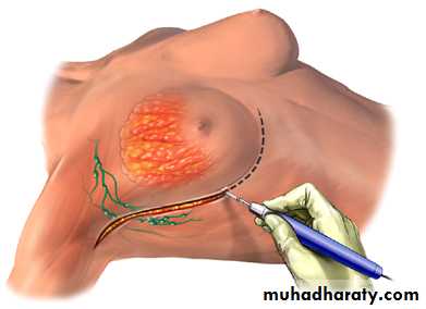 breast cancer