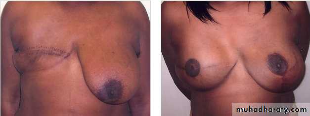 breast cancer