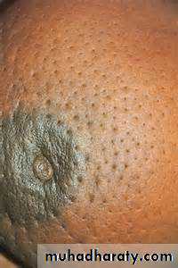 breast cancer
