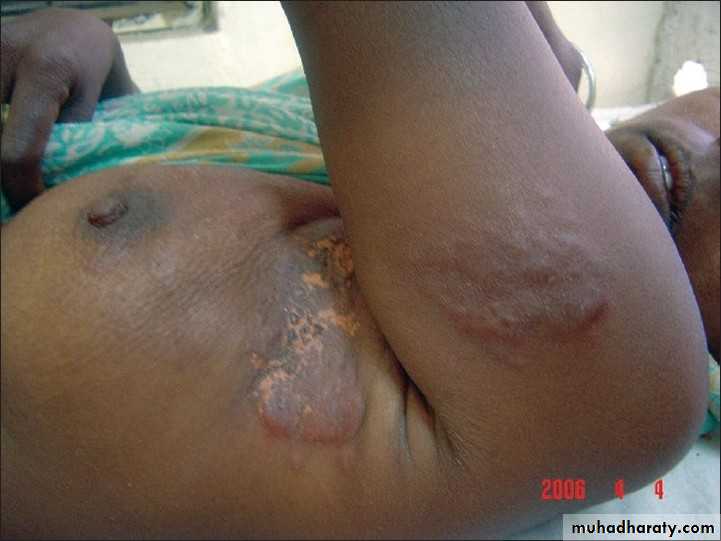 breast cancer