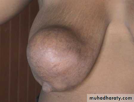 breast cancer