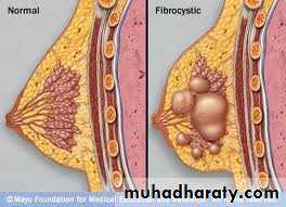 breast cancer