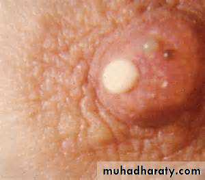 breast cancer