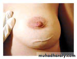 breast cancer