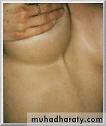 breast cancer