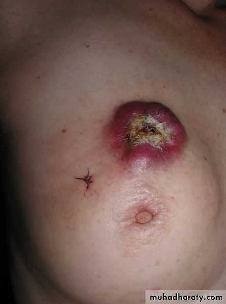 breast cancer
