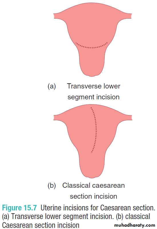 Cesarean Section