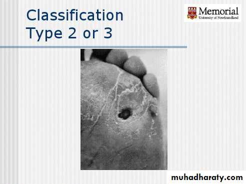 Diabetic foot
