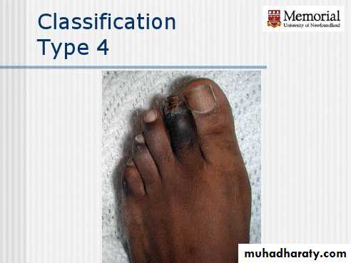 Diabetic foot