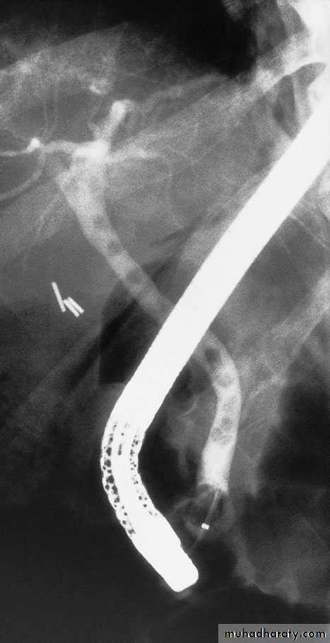 biliary