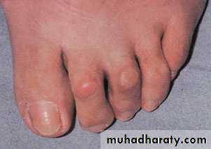Diabetic foot