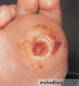 Diabetic foot