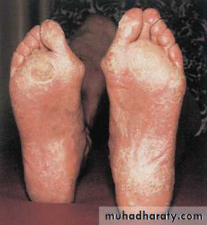 Diabetic foot