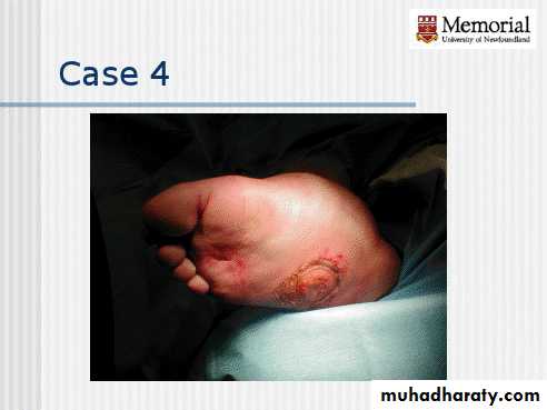 Diabetic foot