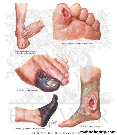 Diabetic foot