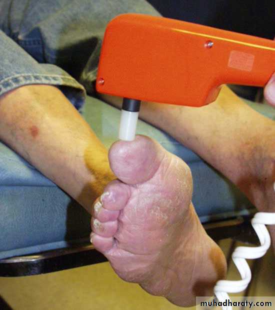 Diabetic foot