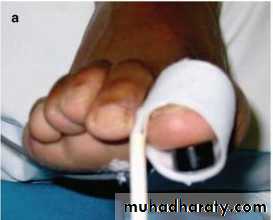 Diabetic foot