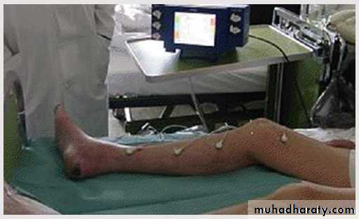 Diabetic foot