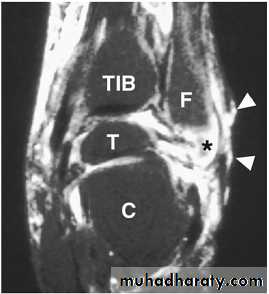 Diabetic foot