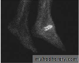 Diabetic foot