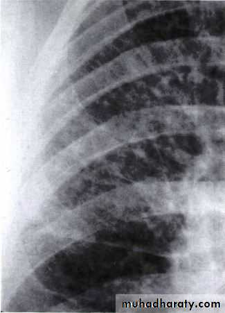 Respiratory