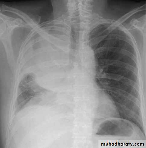 Respiratory