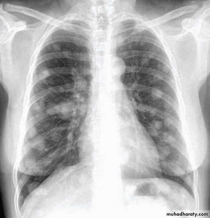 Respiratory