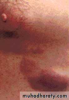 Hematopathology