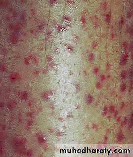 Hematopathology