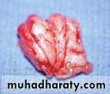 OME AND OTOSCLEROSIS
