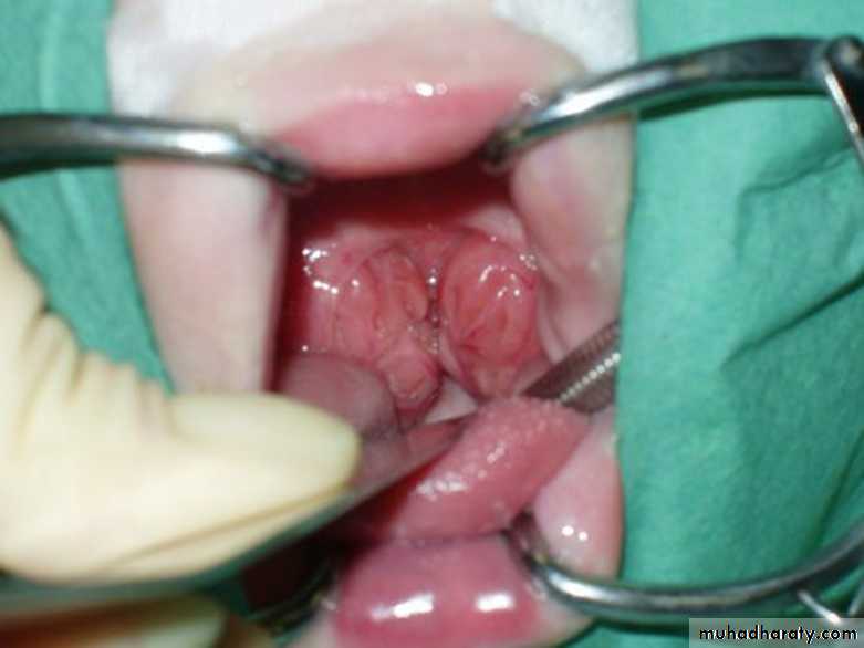 OME AND OTOSCLEROSIS