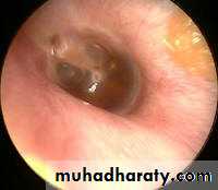 OME AND OTOSCLEROSIS