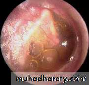 OME AND OTOSCLEROSIS