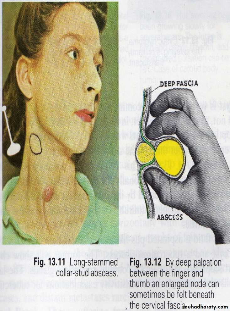 lymphatic diseases of the neck