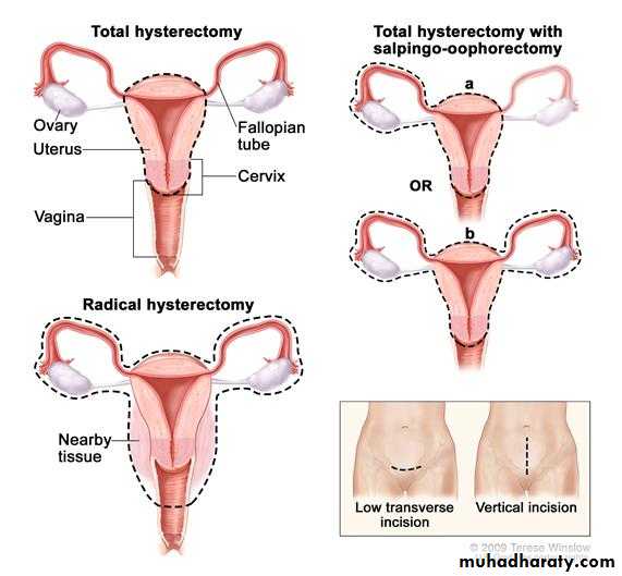 operative gynecology