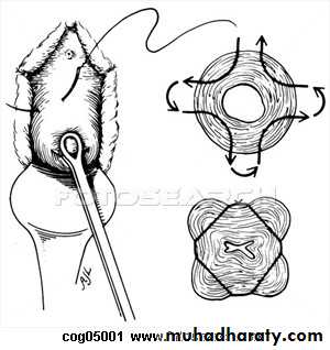 operative gynecology
