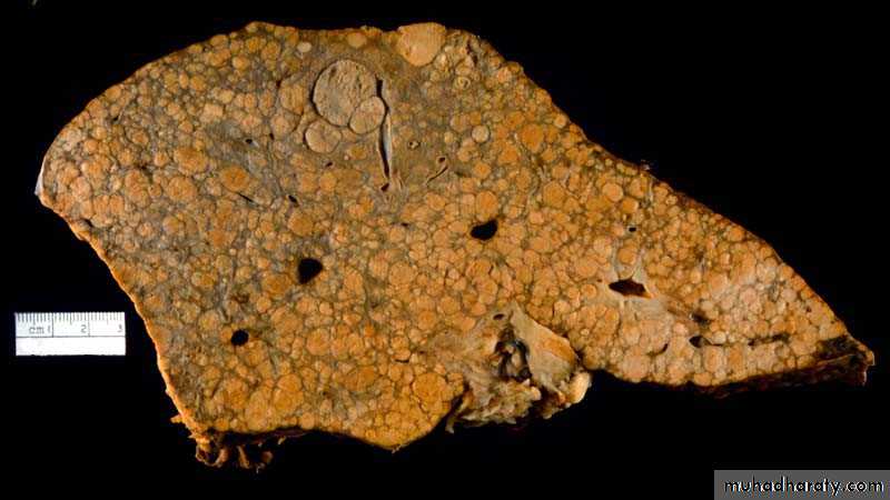 Viral Hepatitis