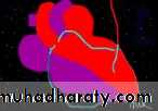 heart failure