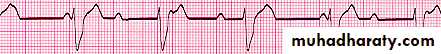heart failure