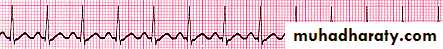 heart failure