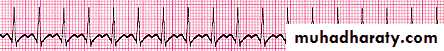heart failure