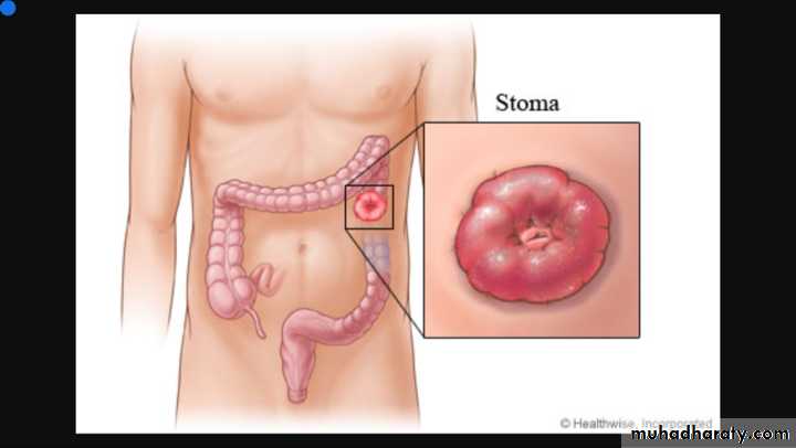 Diseases of large bowel