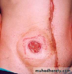 Diseases of large bowel