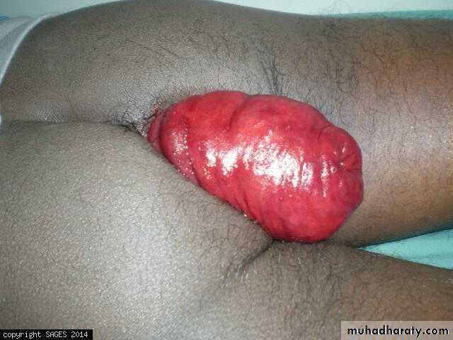 Diseases of large bowel