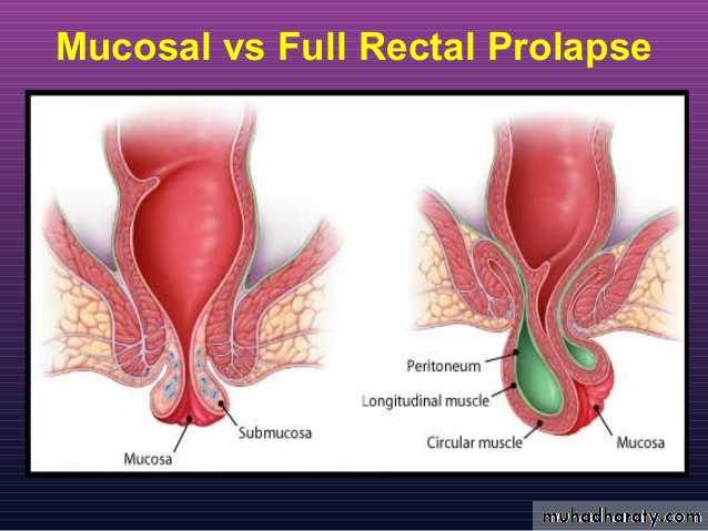 Diseases of large bowel