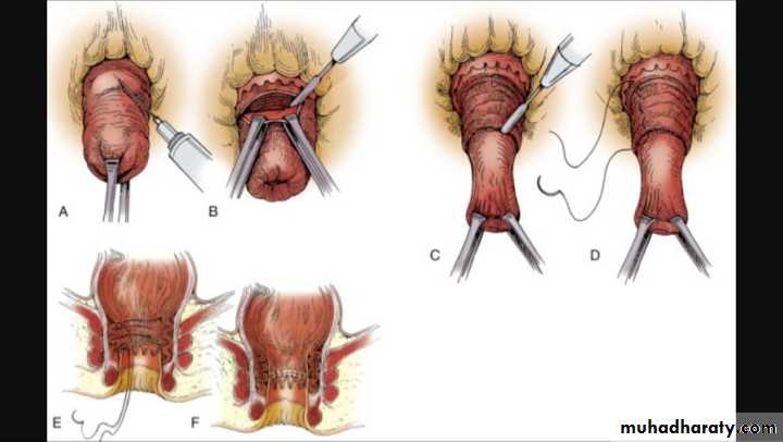 Diseases of large bowel