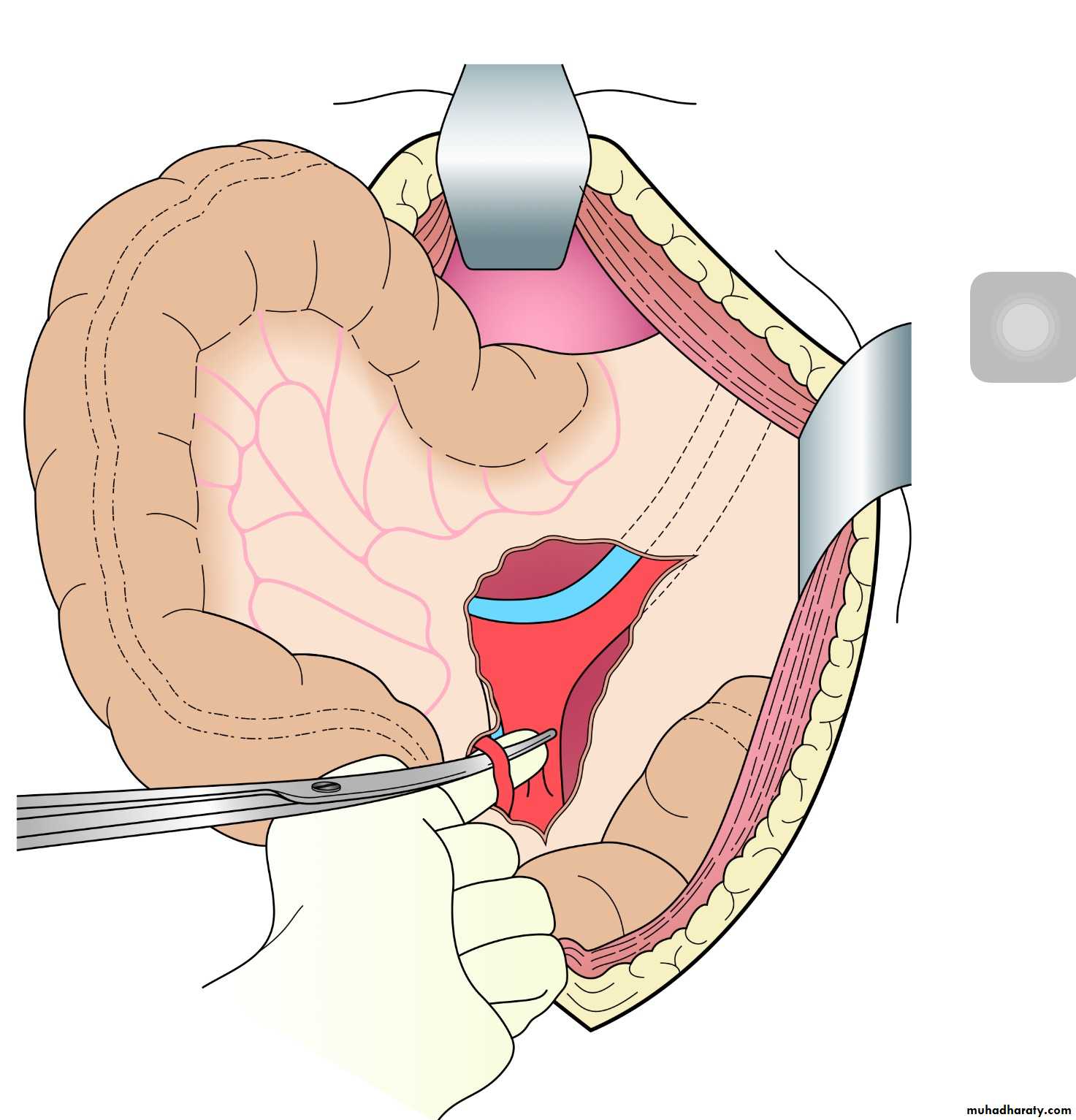 Diseases of large bowel