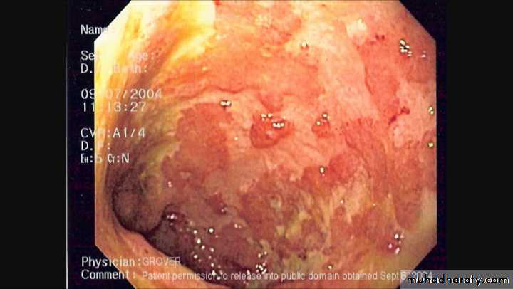 Diseases of large bowel