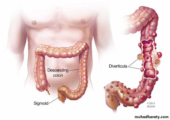 Diseases of large bowel